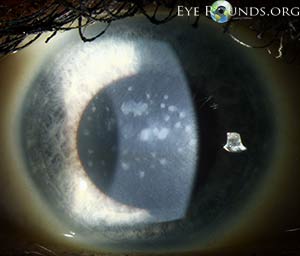 Inherited Eye Disease: Online Atlas of Ophthalmology