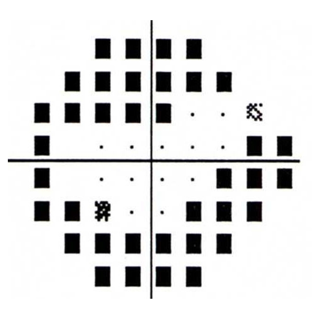 https://eyerounds.org/books/glaucoma_guide/imgs/Ch01/fig-1-12.jpg