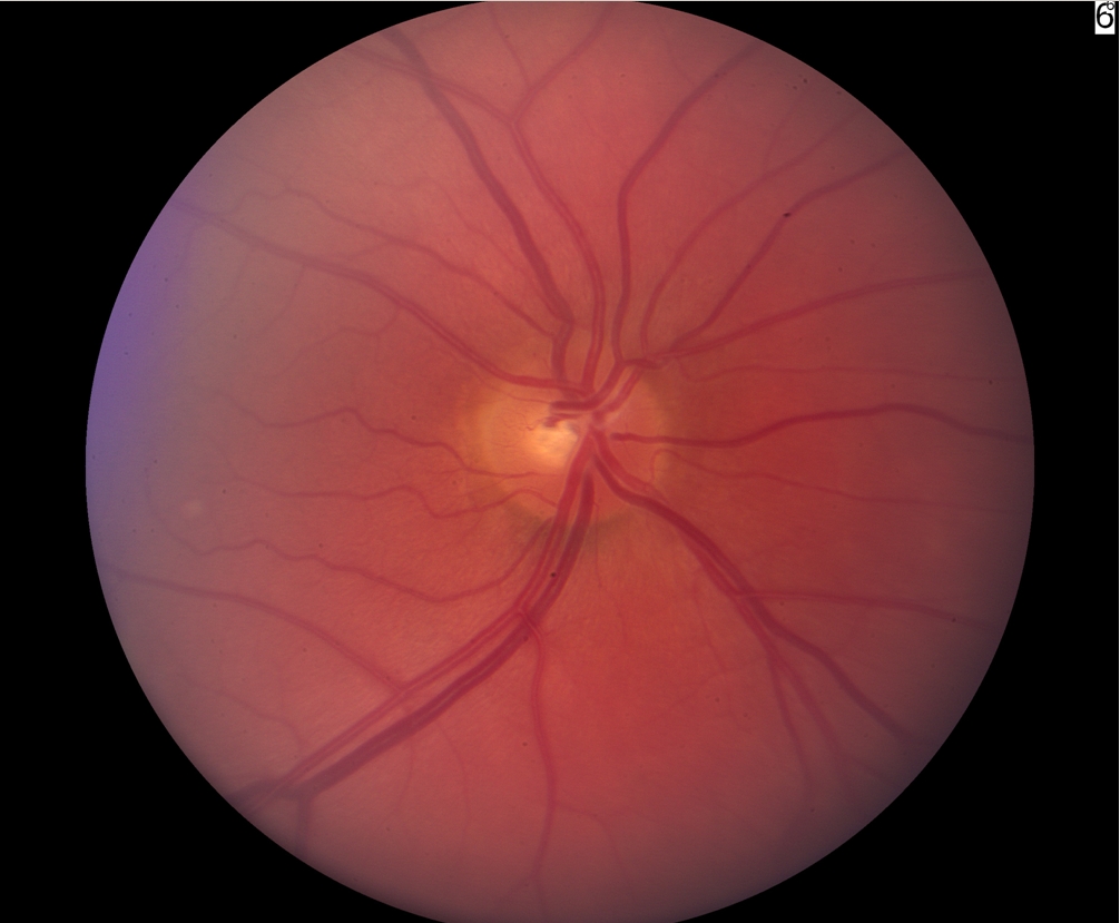 Ch 1 Glaucoma Optic Nerve Disease A Patient s Guide To Glaucoma