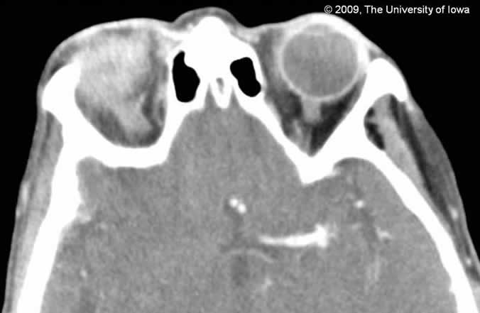 Figure 3, Axial CT scan