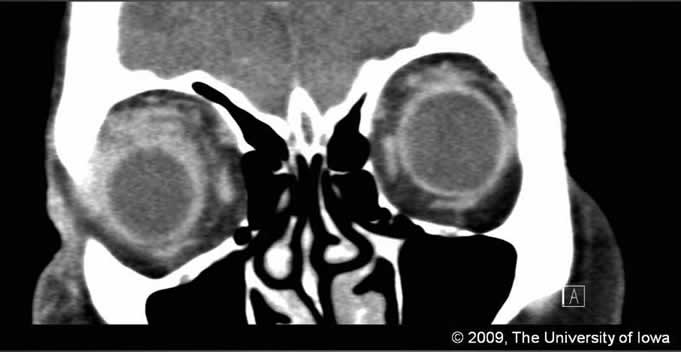 Figure 4. Coronal CT scan