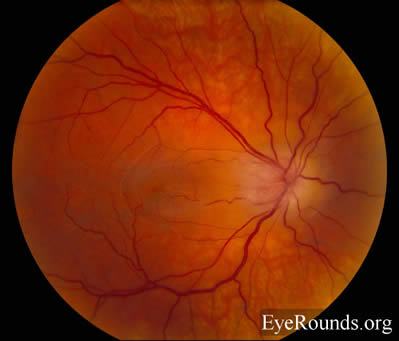 idiopathic recurrent neuroretinitis, leber's stellate neuroretinitis, bartonella henslae, cat-scratch disease, macular star