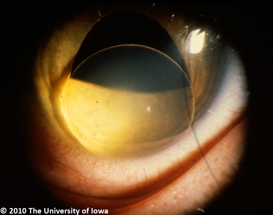 Tijdreeksen Aja Detecteren Marfan Syndrome. EyeRounds.org - Ophthalmology - The University of Iowa