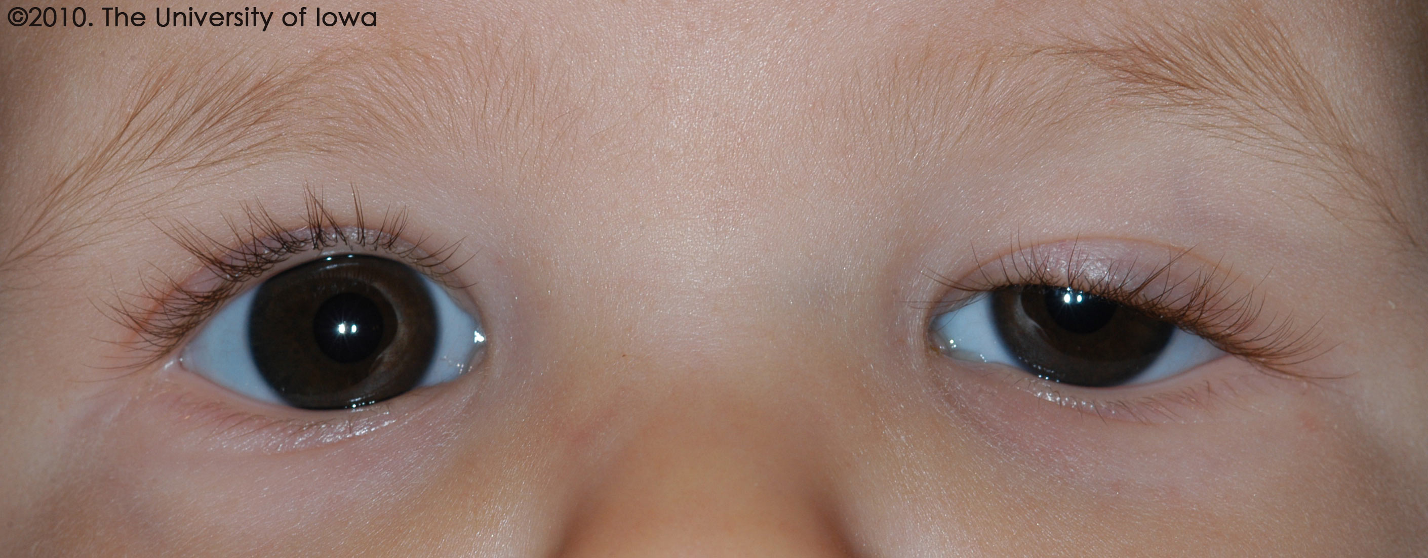   ptosis of the left upper eyelid