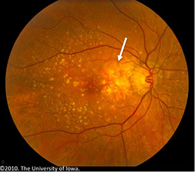 Right eye, color fundus