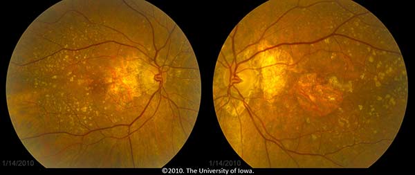 Color fundus photos after treatment with Avastin in left eye