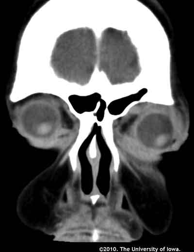 Figure 3: Maxillofacial CT without contrast demonstrating a diffuse mass in the superior aspect of the left orbit. 