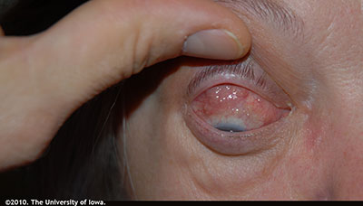Figure 6: Note the conjunctival granulomas on the bulbar conjunctiva of this patient with known CSS.