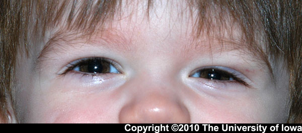 Figure 1. superotemporal swelling over the left upper eyelid