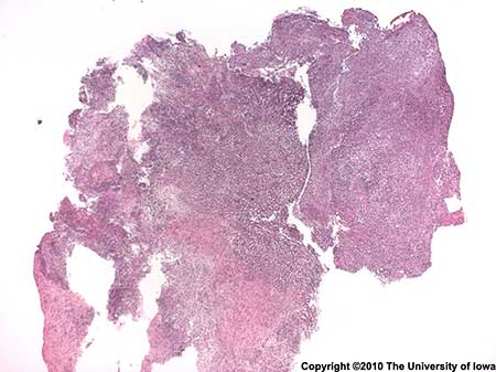 Figure 5: Low power (20X) view of the biopsied tissue demonstrates an infiltrate of neutrophils, histiocytes with somewhat atypical nuclear features, multinucleated giant cells, and occasional eosinophils (deep red nuclei) with focal areas of necrosis, consistent with eosinophilic granuloma. 