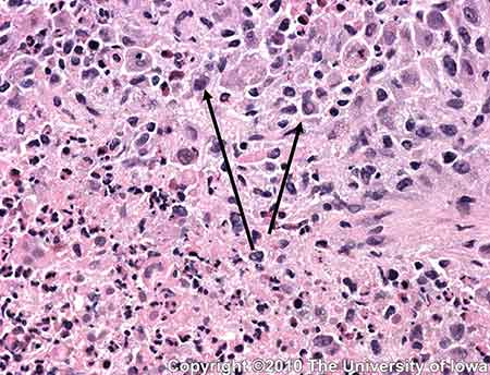 Figure 6: A higher power view (200X) demonstrates a more detailed view of the multicellular infiltrate described above. Atypical nuclei are indicated by arrows.