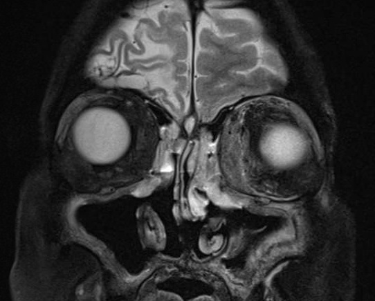 MRI of brain with gadolinium