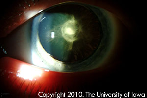 Slit lamp photo of the posterior polar cataract of the left eye. Note the posterior subcapsular change and anterior subcapsular/cortical spokes
