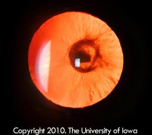 Red reflex of the left eye demonstrating the posterior polar cataract