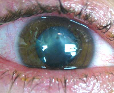 Intraocular Foreign Body, caption above for details)