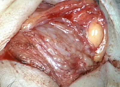 Intraoperative photograph of the lacrimal gland