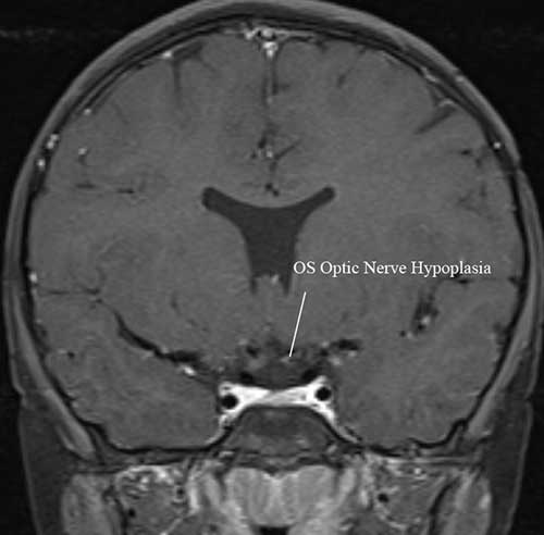MRI Brain, coronal t1 FS think post GAD