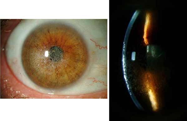 Slit lamp photos of right eye showing granular white opacities at the LASIK flap interface level