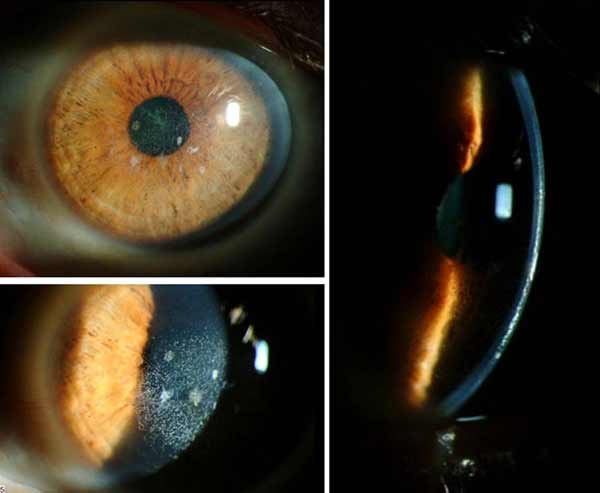 Slit lamp photos of the left eye after superficial keratectomy and PTK