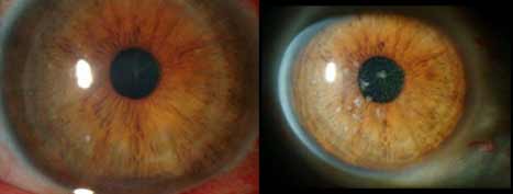 Slit lamp photo of the right eye POD#3 after IntraLase-enabled superficial anterior lamellar keratoplasty, with preoperative photo on the right for comparison (click image for higher resolution photo) 