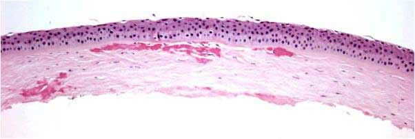 Eosinophilic deposits are noted in the anterior stroma and at the stromal interface