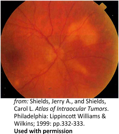 horoidal lesions