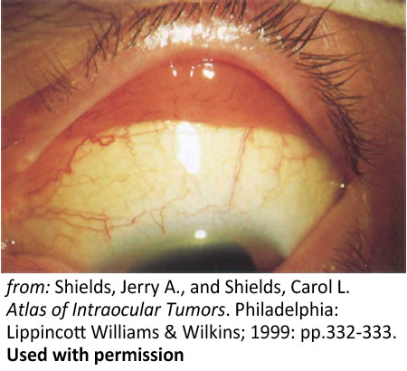 Conjunctival lesions