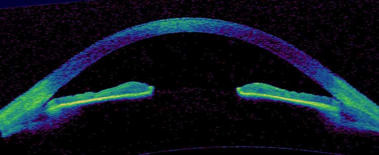 OCT after Laser peripheral iridotomy