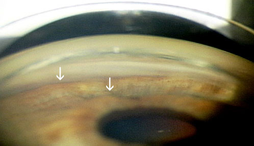 The iris drapes over the ciliary body producing the characteristic sine wave or double hump