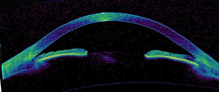 OCT: Before Laser peripheral iridotomy