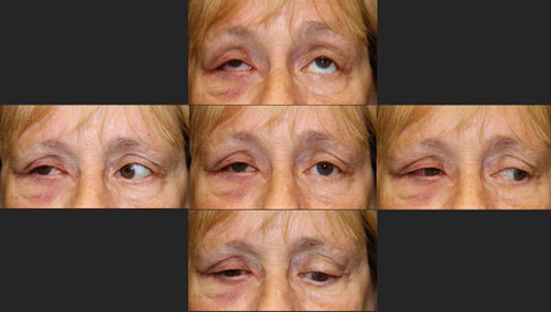 Figure 2: External photogra[hs demonstrating ptosis and limited extraocular motility of the right eye
