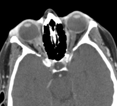 Figure 3. CT scan demonstrating enophthalmos and an ill-defined intraconal lesion of the right orbit.?
