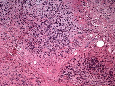 Figure 5.? H&E Stain of orbital mass biopsy which demonstrates a dense infiltrate of spindle shaped to round cells with scant cytoplasm and hyperchromatic nuclei. The cells demonstrated an infiltrative growth pattern