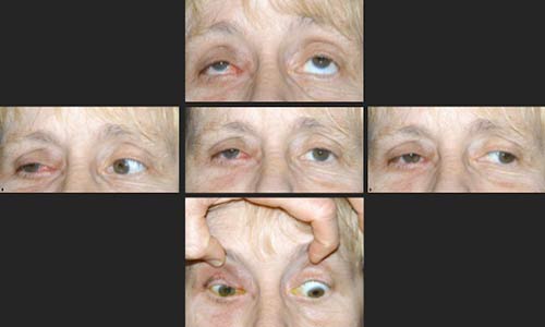 Figure 7.? Post-radiation external photographs demonstrating ptosis and limited extraocular motility of the right eye.