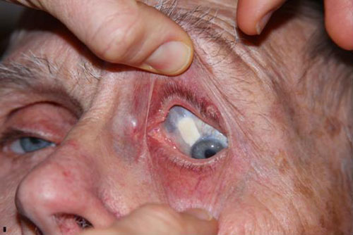 Figure 2: Photo of conjunctiva demonstrating scleral patch graft and large bleb in superonasal quadrant. 