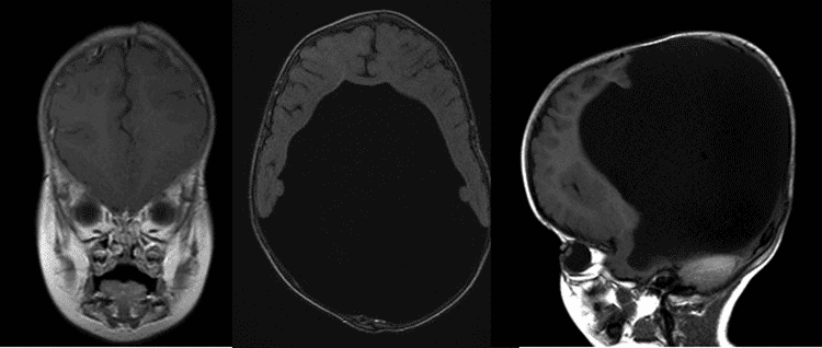 Figure 1: Axial and saggital MRI illustrating the enlargement of ventricles secondary to hydrocephalus. 