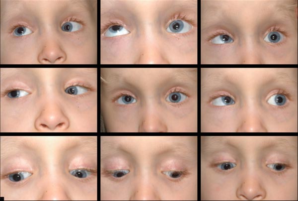 Figure 4: Pre-operative photos demonstrating variable residual esotropia of 16 -20delta and left hypotropia of 16-18delta. Motility exam is notable for elevation deficit OS consistent with a monocular elevation deficiency. The left lower eyelid appears to have an accentuated lower eyelid, or a Scott Sign, which is suggestive of a tight inferior rectus and commonly seen in monocular elevation deficiency (Scott, 1977).