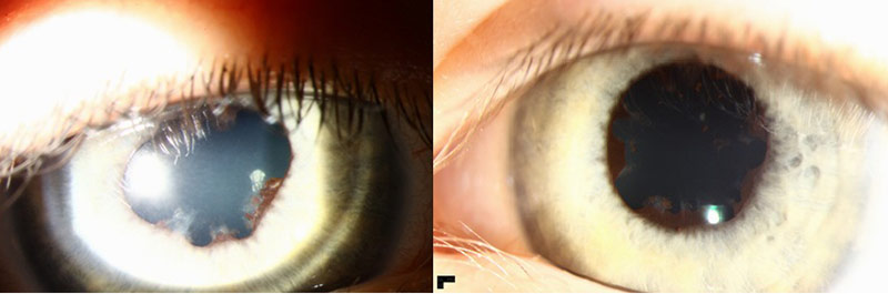 Figure 1: Color slit-lamp photographs of central posterior synechiae OU