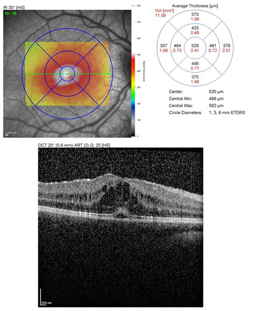 Figure 2: Heidelberg OCT image showing cystoid macular edema in the right eye