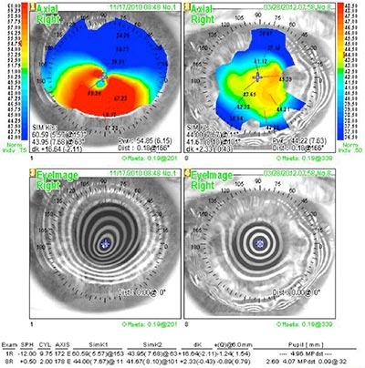 A comparison of preoperative and postoperative corneal topography shows the benefit of DALK