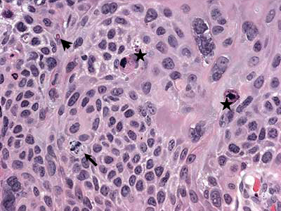 Higher magnification photomicrograph showing lack of normal maturation (dysplasia) with atypical cells with large irregular nuclei and prominent nucleoli. Mitoses and apoptotic bodies are present along with focal dyskeratosis (keratin pearls)