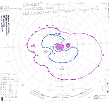 Goldmann visual field test OD demonstrating a central scotoma and superior constriction of the visual field. There is no I2e isopter.