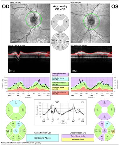 Optical coherence tomography (OCT) of optic nerve