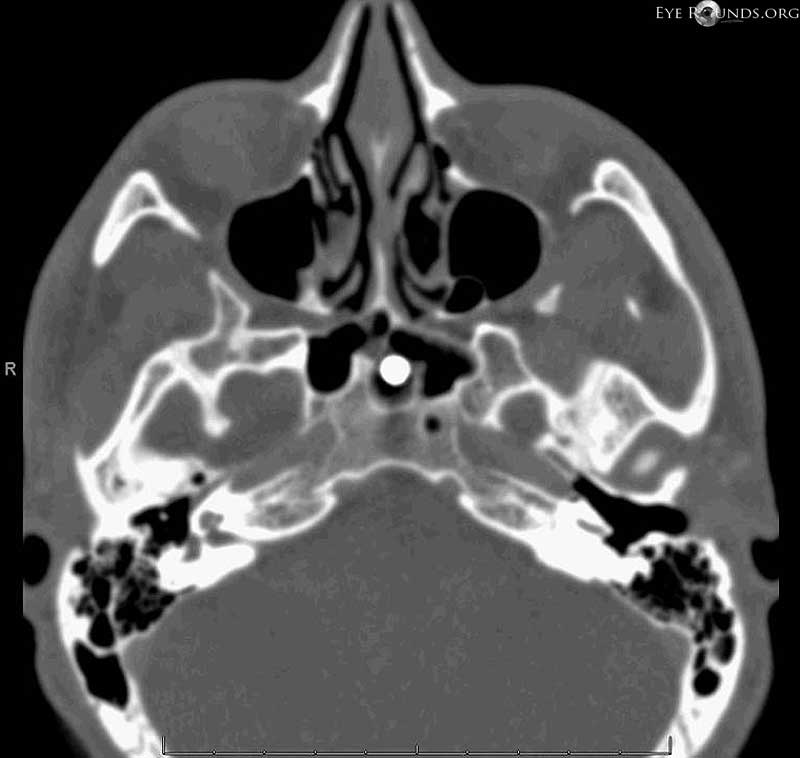 CT scan