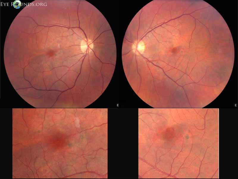 Pattern Dystrophy