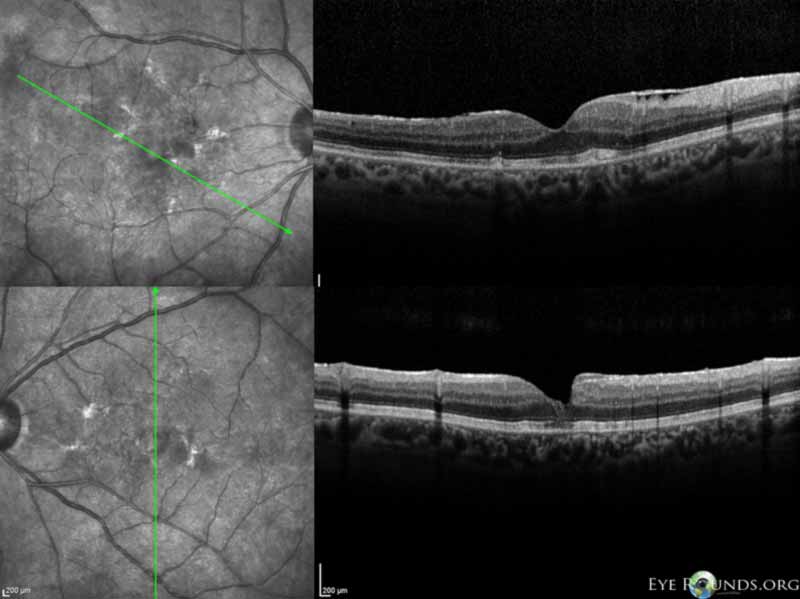 Optical Coherence Tomography (OCT) images demonstrate an ERM along with hyper-reflective material in the outer retinal layers causing dome-shaped elevations OD