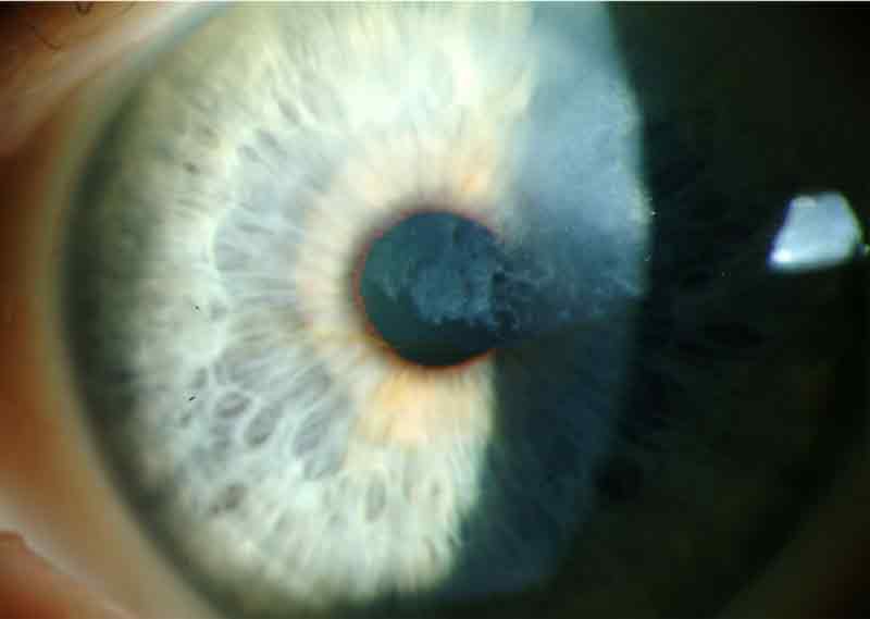 Salzmann Nodular Corneal Degeneration, left eye