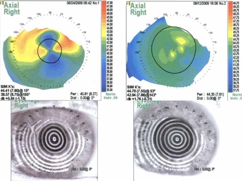 Right eye topography after superficial keratectomy. The overall corneal curvature is reduced with substantial reduction of both regular and irregular astigmatism