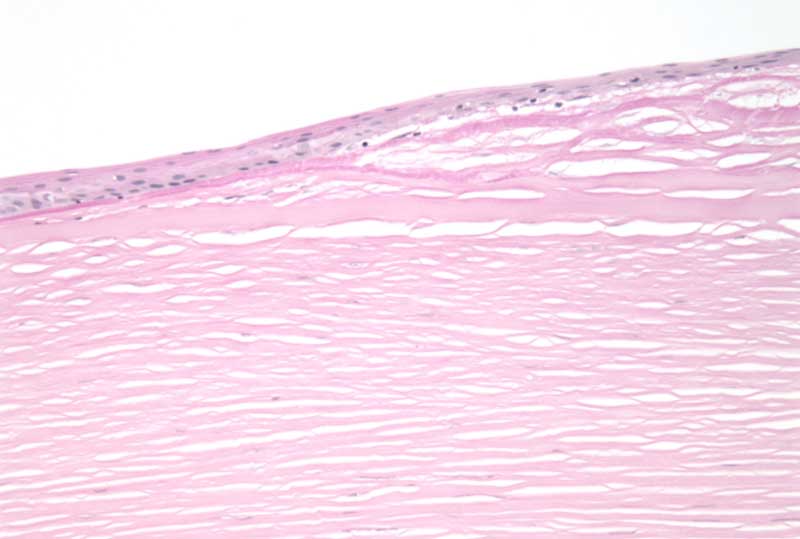 Periodic acid Schiff stain highlights the thickened, irregular epithelial basement membrane.?100x