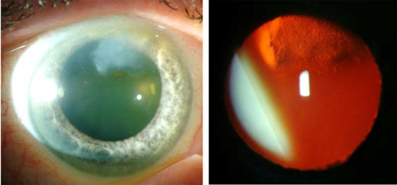 Slit lamp photo of the left eye of another patient with a superior Salzmann's nodule.
